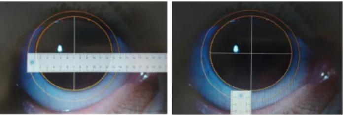 Fig. 7. Measurement of post-blink movement with the soft  contact lens using the Adobe Premiere Pro CC program  (a) immediately after blinking and (b) after stabilization.