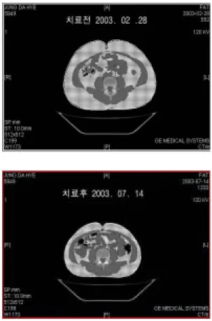 Table  Ⅱ.  Change  of  Indexes  of  Obesity