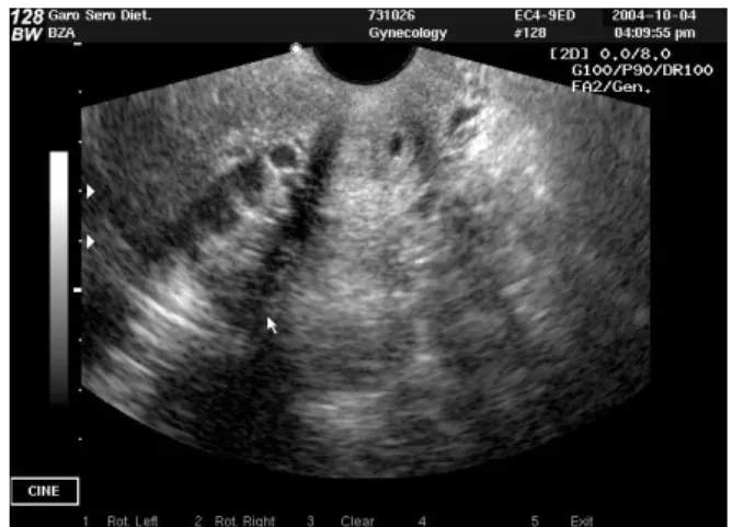 Fig. 1. Polycystic ovary