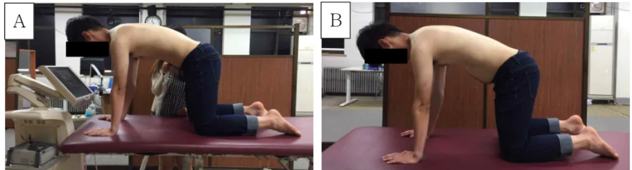 Figure  2.  Push-up plus exercise (A: without abdominal drawing-in maneuver, B: with abdominal drawing-in maneuver).