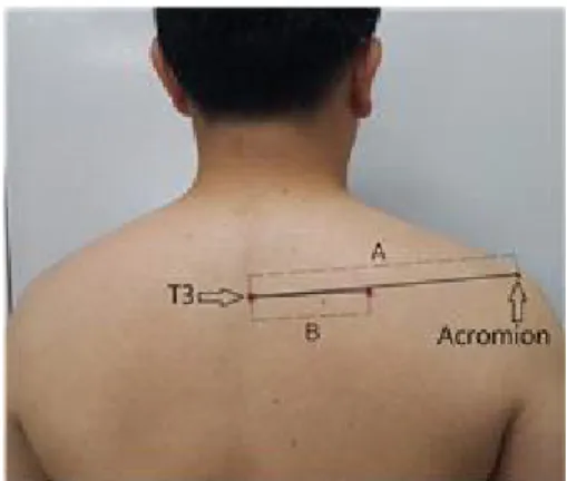 Figure  2. Scapular size was measured by the distance difference value between (A) from the 3rd thoracic spinous process to posterolateral acromion and (B) from the 3rd thoracic spinous process to root of the scapular spine.