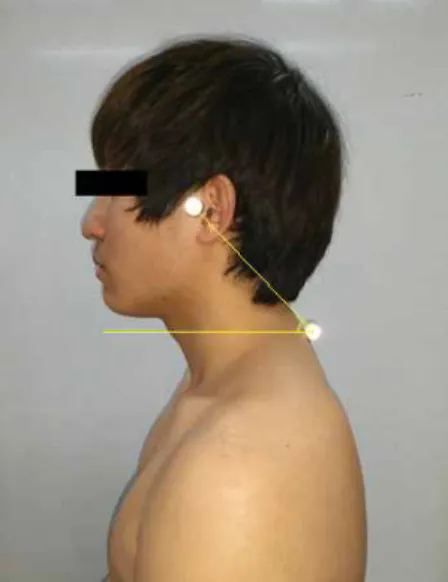 Figure  1.  Measurement of craniovertebral angle (CVA).