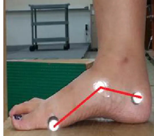 Figure  1.  The medial longitudinal arch angle.