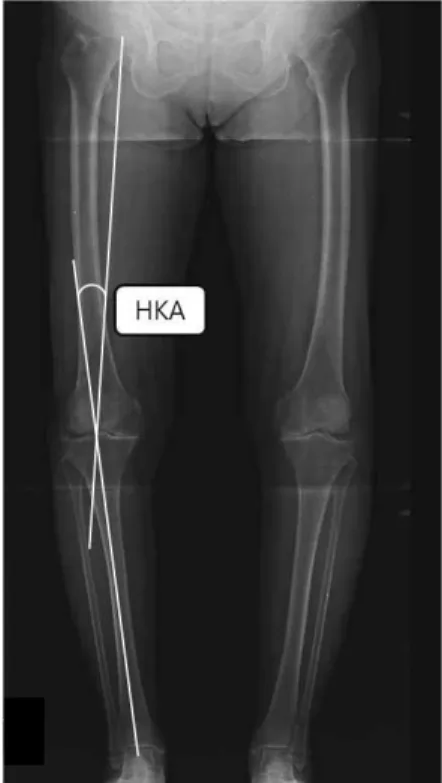 Figure  1.  Negative value (knee varus) hip-knee-ankle angle.는 두 군간 차이가 있을 것이다. 넷째, 수술 전과 수술후 TTA 변화량이 두 군간 차이가 있을 것이다.Ⅱ