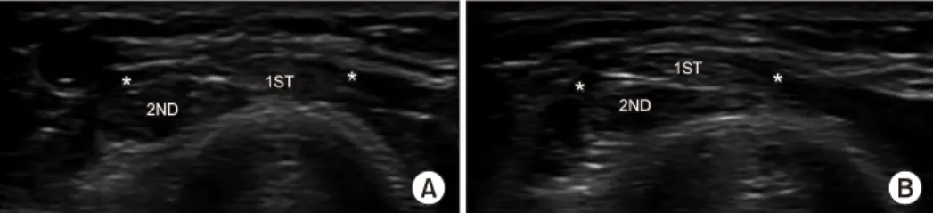 Fig.  3.  Intersection  syndrome.  Transverse  scan  image  obtained  proximal  from  the  Lister’s  tubercle  demonstrates  swelling  and  hypo- hypo-echoic  appearances  (asterisk)  at  the  point  where  the  tendons  of  the  first  compartment  meet  