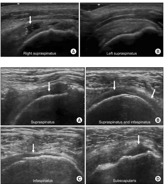 Fig. 1. Longitudinal view of supra- supra-spinatus tendon (A) suprasupra-spinatus  tendon full thickness tear (white  arrow, 2.3 cm, medium): “sagging peribursal fat sign” and cortical  irregularities