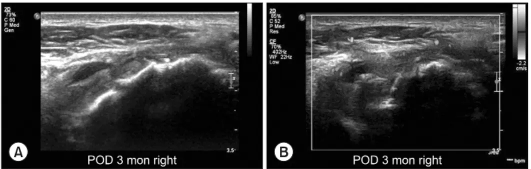Fig. 4. Longitudinal view at 3  months after surgery (A) repaired  tendon show a localized fluid  col-lection within the subacromial-  subdeltoid bursa (B) color Doppler  image shows the vascularity in the  peritendinous and intratendinous  areas.