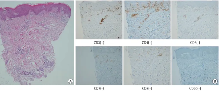 Fig. 5. Progress of peripheral blood eosinophil count. MTX, methotrexate; CVP, cyclophosphamide, vincristine, prednisone.