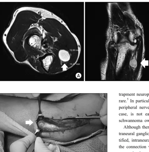 Fig. 3. Operative findings include a thickened ulnar nerve and  a cystic mass (arrow)
