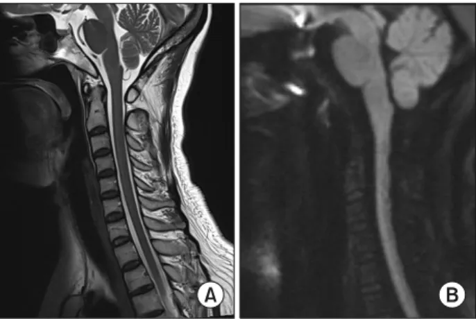 Fig. 2. Cervical MRI was taken 5 days after the symptom onset. Cervical and thoracic MRI showed spinal cord lesions compatible  with spinal cord infarction