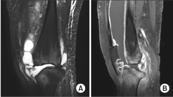 Fig. 2. Front (A) and back view (B) showed varus deformitiy  and swelling of knee joint at 7 months after symptom onset