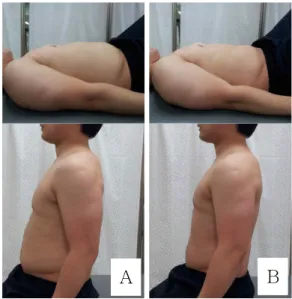 Figure  2.  Abdominal draw-in maneuver (A: starting position, B: finish position).