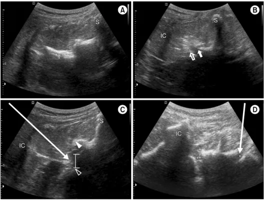 Fig. 1. Schematic view for needle  insertion. (A) At the level of the  lower margin of the L5 transverse  process