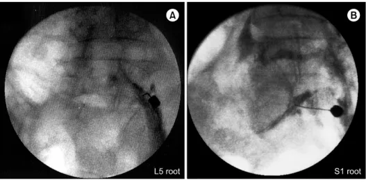 Table 1. Ultrasound-Guided Injection into Lumbar and S1 Roots (n = 48) No. of cases Total L1 L2 L3 L4 L5 S1 Extra-foraminal spread 1 2 1 0 2 1 7/48 (14.6%) Intra-foraminal spread 7 6 7 8 6 7 41/48 (85.4%)