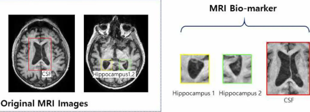 Fig. 1. Example of Hippocampus and CSF as bio-markers in original MRI images.