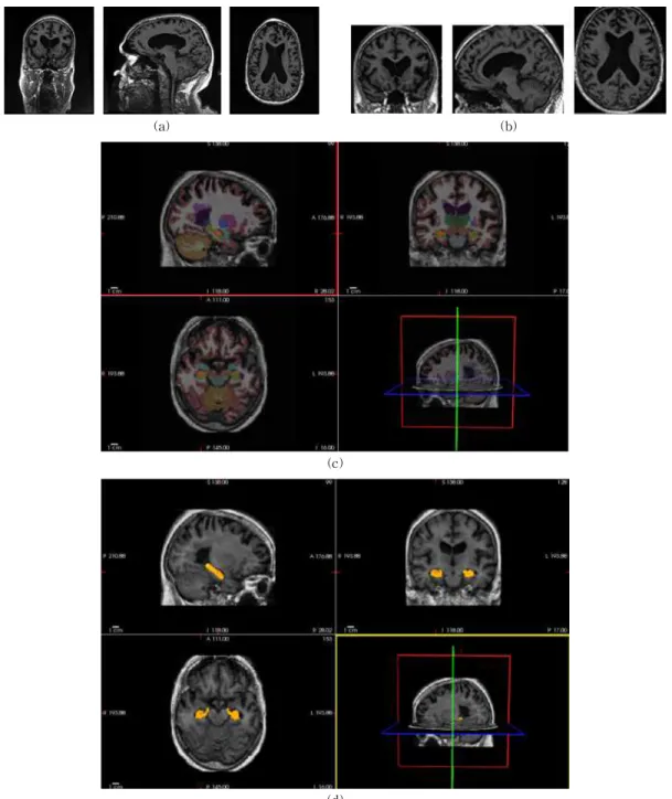 Fig. 5. Visualized example for describing pre-processing of MRI Images. (a) MRI image before normalization