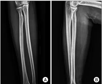 Fig. 1. Bruising of posteromedial side of the Rt. forearm was  seen after injury.