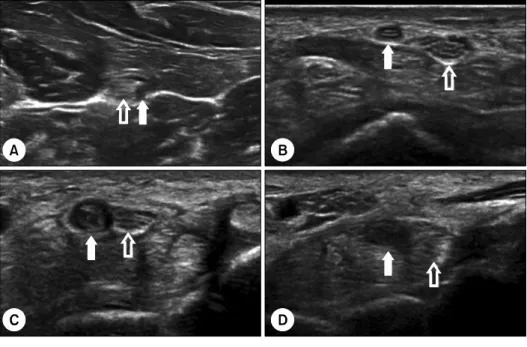 Fig. 2. Ultrasound findings of the right median artery (arrow). On the longitudinal B-mode image (A) and color doppler image (B),  the thrombi (void arrow) was clearly visualized occluding distal blood flow.