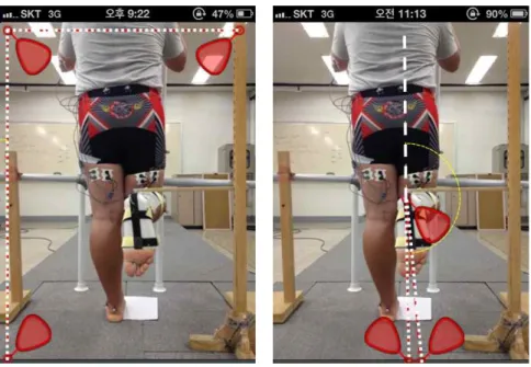 Figure  1. Three different markers with gravity sensor can be placed to calculate tibial external rotation angle performed in the frontal plane by DrGoniometer measurement.