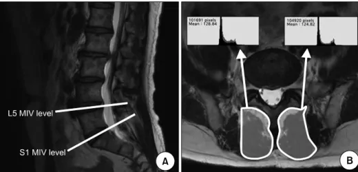 Fig.  2.  An  example  of  cross-sectional  area  and  signal  intensity  measurements  of  the  multifidus  muscles  in  a  patient  with  unilateral  L5  radiculopathy
