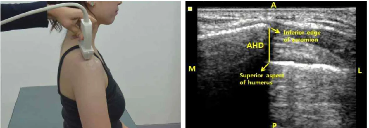 Figure  3. Acromiohumeral distance (AHD) (A: anterior, P: posterior, M: medial, L: lateral).