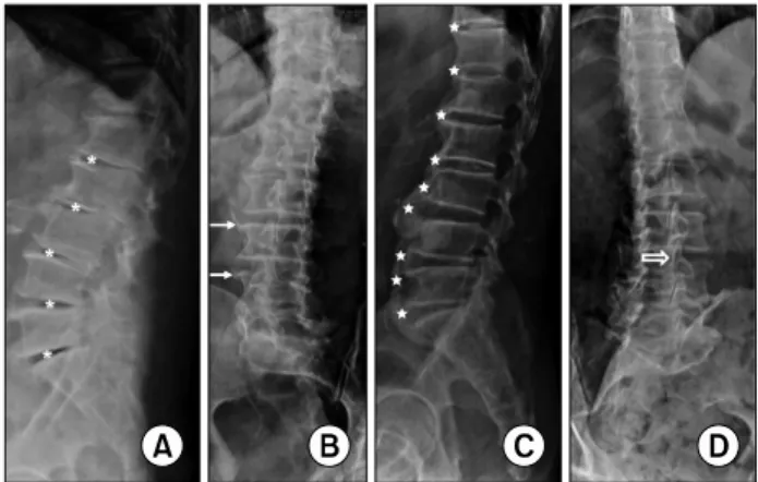 Fig.  1.  Simple  lateral  (A,  C)  and  oblique  (B,  D)  X-ray  findings  of  intervertebral  osteochondrosis  (A),  spondylosis  deformans  (B),  diffuse  idiopathic  skeletal  hyperostosis  (DISH)  (C),  and   os-teoarthritis  of  the  facet  joint  (D