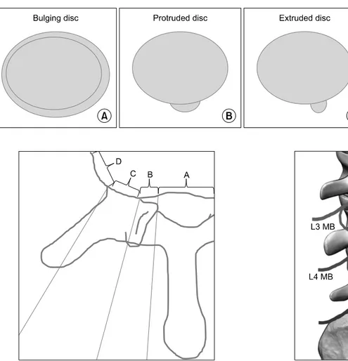 Fig.  3.  Schematic  drawings  of  the  bulging  disc  (A),  protruded  disc  (B),  and  extruded  disc  (C)