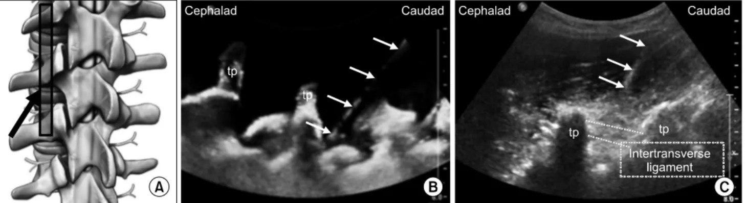 Fig.  9.  Pararadicular  epidural  injection.  Schematic  picture  (A)  for  needle  direction  (black  arrow)  and  transducer  position  and  long-axis  US  images  of  phantom  (B)  and  real  person  (C)  with  5-1  MHz  curved  transducer