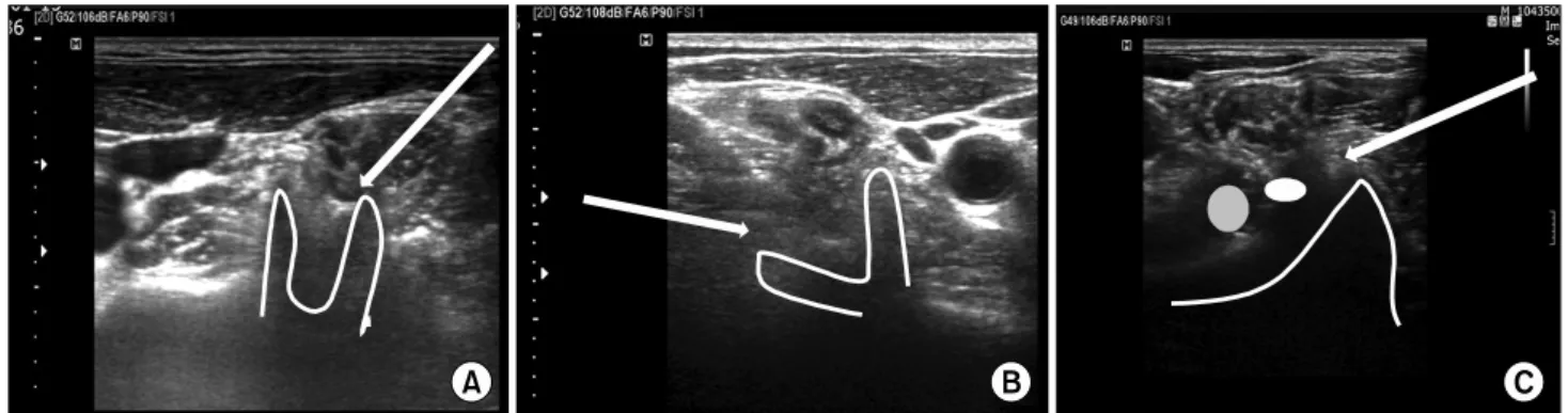 Fig.  1.  Characteristic  features  of  cervical  transverse  process  of  C5-7.  (A)  Anterior  tubercle  and  posterior  tubercle  of  C5  makes  two  humped  camel  sign  and  C5  spinal  root  is  located  between  two  tubercles