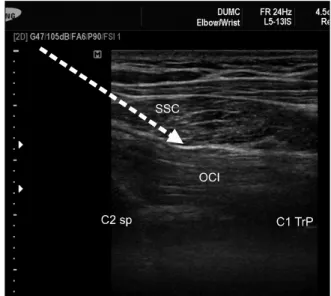 Fig.  5.  Ultrasound  findings  of  greater  occipital  nerve  (GON). 