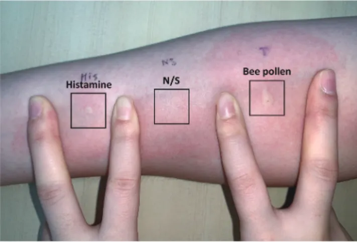 Fig. 1. Bee pollen ingested by the patient. Fig. 2. Skin prick test results using bee pollen ingested by the patient
