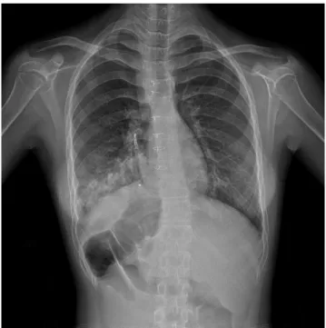 Fig. 1. The chest x-ray finding of the patient. An increased pulmonary opacity  was found in right lower lung field.