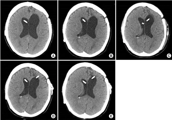 Fig.  1.  Serial  coronal  brain  CTs  of  the  hydrocephalus  from  March  2 nd ,  2014  to  April  20 th ,  2016