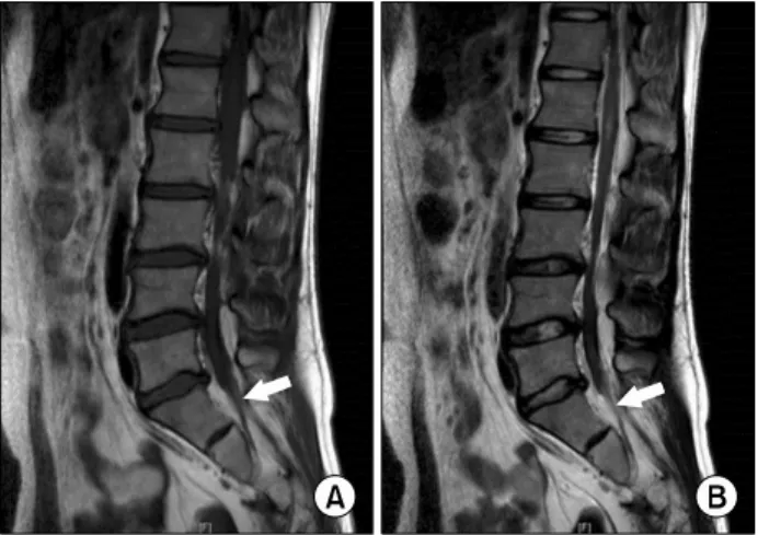 Fig.  2.  Sagittal  MRI  in  T1-weighted  (A)  and  T2-weighted  im- im-ages  (B)  showed  that  the  caudal  end  of  the  spinal  cord  is   anch-ored  around  the  sacral  area  (arrow).