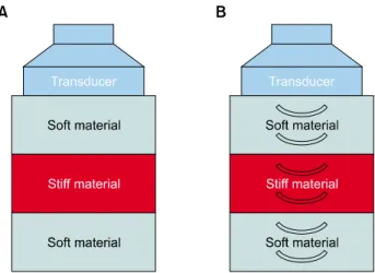 Fig.  1.  Compression  method  of  sonoelastography.  (A)  Manual  compression.  (B)  Acoustic  radiation  force  impulse.