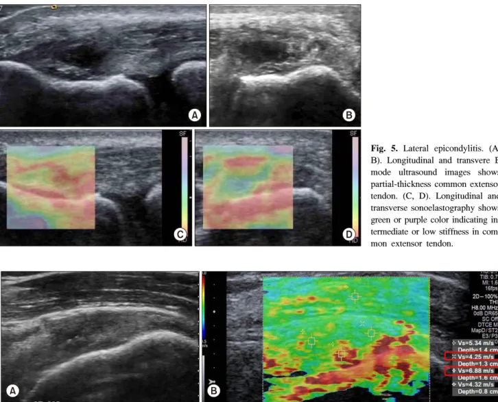 Fig.  5.  Lateral  epicondylitis.  (A,  B).  Longitudinal  and  transvere  B  mode  ultrasound  images  shows  partial-thickness  common  extensor  tendon