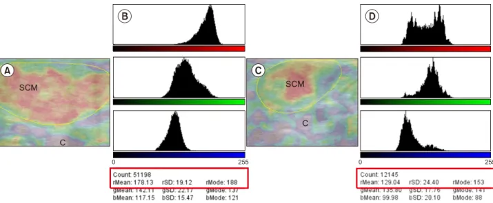 Fig.  8.  Representative  RTS  and  color  histogram  changes  of  red  pixel  intensity  of  affected  SCM