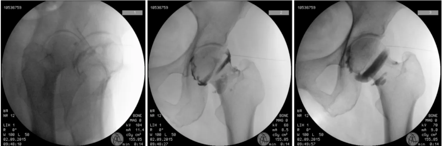 Fig.  1.  Fluoroscopic  guided  hydraulic  distension  of  hip  joint.