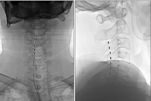 Fig.  3.  Spinal  cord  stimulator. 