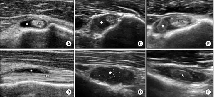 Fig.  1.  Several  pathologic  conditions  of  intra-articular  portion  of  the  long  head  of  the  biceps  brachii  tendon  (lhb)