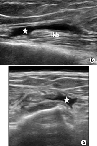 Fig.  3.  Total  rupture  of  the  long  head  of  the  biceps  brachii  ten- ten-don  (lhb)  at  the  tenten-don  proper