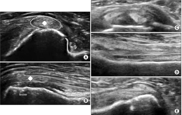 Fig.  4.  Partial  or  total  dislocation  of  the  long  head  of  the  biceps  brachii  tendon