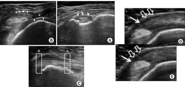 Fig.  7.  Coracohumeral  ligament  and  the  capsular  thickening  at  the  rotator  cuff  interval  in  patient  with  severe  adhesive  capsulitis