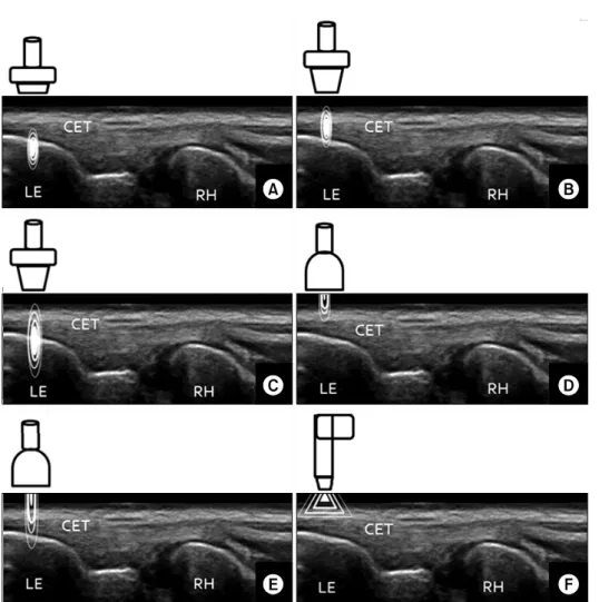Fig.  1.  Different  focal  geometry  ac- ac-cording  to  various  devices.  (A,  C)  Depth  of  focal  area  appears  to  be  too  much  deep  for  the  treatment  of  common  extensor  tendinopathy