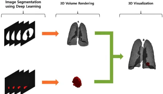 Fig. 4. 3D object of lung and nodule region read in Unity.