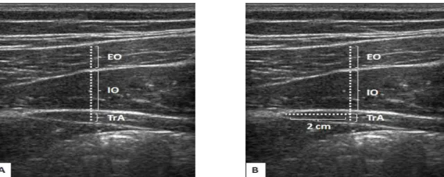 Figure 3. Captured images of the three different probe locations. A: probe location 1 (PL1), B: probe location 2 (PL2), C: probe location 3 (PL3), the medial edge of the TrA in the circle