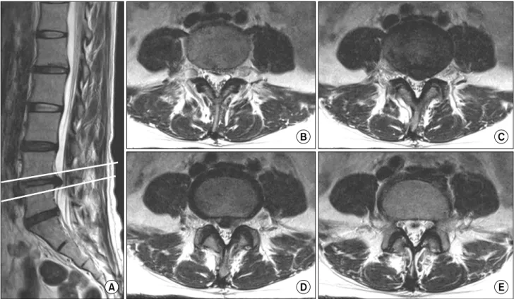 Fig.  1.  Based  on  the  sagittal  view  (A),  several  T2-weighted  axial  images  were  selected  starting  from  the  image  cut  (B)  just  above  the  upper  margin  of  herniated  disc  material  to  the  image  cut  (E)  just  below  the  lower  ma