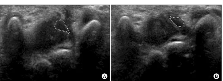 Fig.  2.  Cross  sectional  area  of  median  nerve  at  pisiform  bone  measured  by  ultrasonography  after  carpal  tunnel  release  operation
