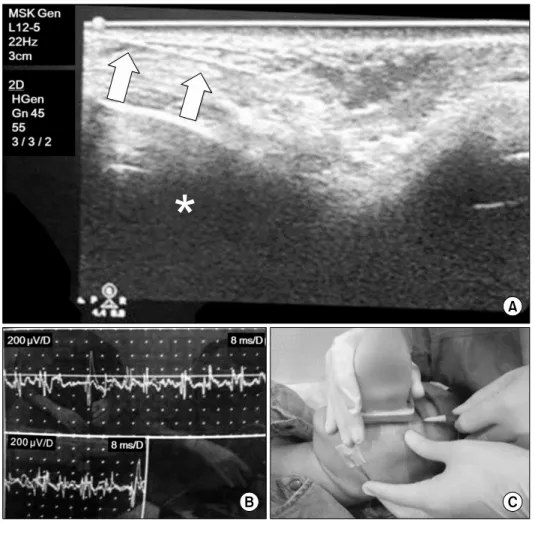 Fig.  1.  Synkinesis  study  with  left  eye  blinking.  (A)  Left  levator  labii  superioris  muscle