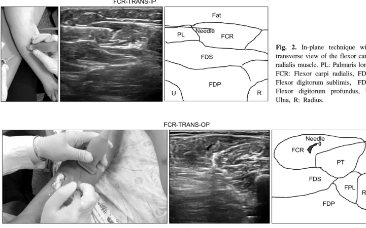 Fig.  2.  In-plane  technique  with  transverse  view  of  the  flexor  carpi  radialis  muscle